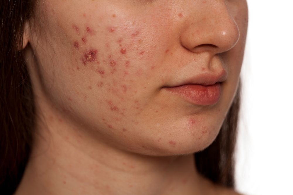 marcas de acné