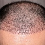 que es la alopecia androgénica